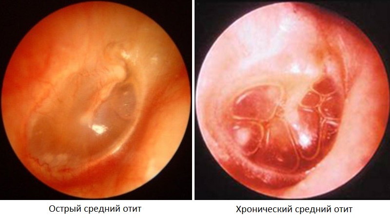 vospaleniesrednegouxasimptomiilecheniech E32347C5 - Воспаление среднего уха у взрослых – причины, симптомы и лечение воспаления среднего уха