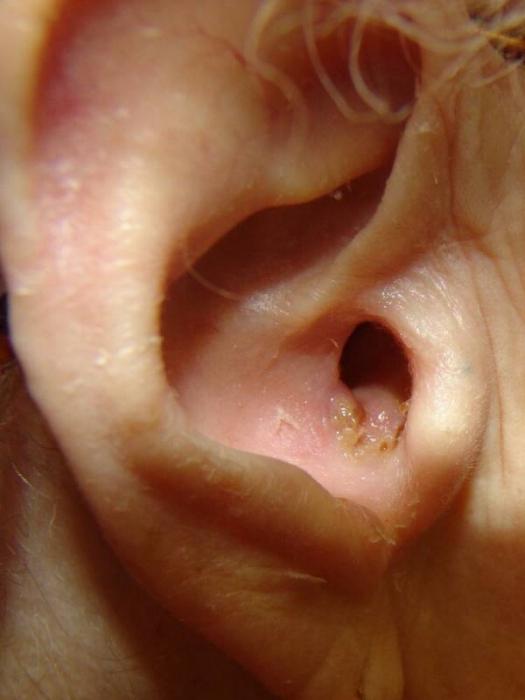 vospalenieusheyprichinisimptomiimetodile F85AECC9 - Воспаление среднего уха у взрослых – причины, симптомы и лечение воспаления среднего уха