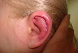 vospalenieushnoyrakoviniperixondritprizn 2EC1858A - Перихондрит ушной раковины: симптомы, лечение, фото