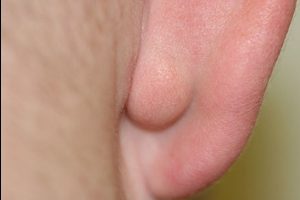 vospalilsyalimfouzelzauxomprichiniisimpt 2CF56665 - Воспаление лимфоузлов за ухом
