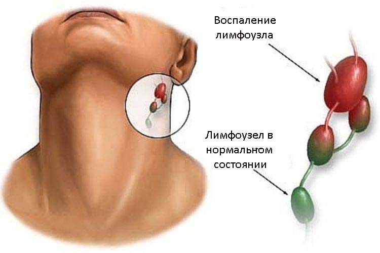 vospalilsyalimfouzelzauxomprichiniisimpt F0CD450D - Воспаление лимфоузлов за ухом