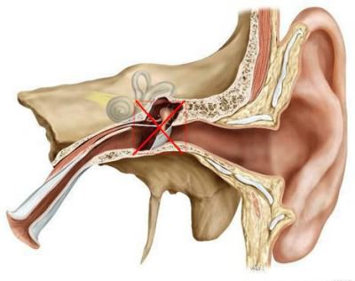 vosstanovleniesluxaposleotita 8377AB5D - Как восстановить слух после отита: официальная медицина, упражнения для слуха, массаж