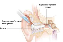 vozmozhnieoslozhneniyaposleotita 412E5456 - Осложнения отита: последствия и восстановление слуха