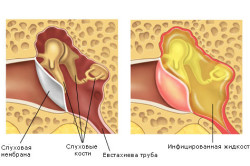 vozmozhnieoslozhneniyaposleotita CC2DDA50 - Осложнения отита: последствия и восстановление слуха