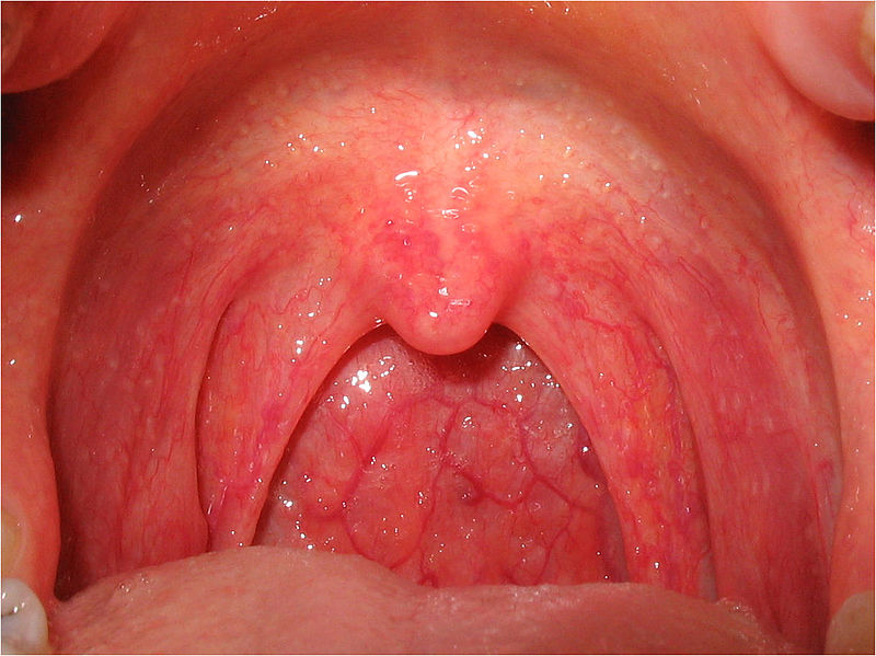 vsevidifaringitassimptomamilecheniemifot 8A772B3E - Грибок в горле: причины развития заболевания, фото кандидоза гортани и лечение
