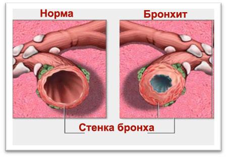 xronicheskiybronxitsimptomiilechenieuvzr 8DE4D943 - Хронический бронхит — диффузное воспаление слизистой оболочки бронхов