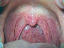 xronicheskiyfaringitfotosimptomiilecheni 09F1CB6A - Хронический фарингит у взрослых — симптомы и лечение