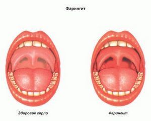 xronicheskiyfaringitlechenienarodnimisre 4DED6609 - Гнойные язвочки во рту и причины их появления, а также виды болячек полости рта и их лечение