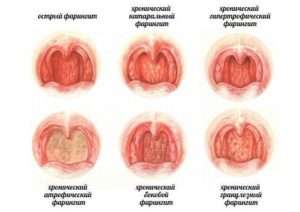 xronicheskiyfaringitsimptomilechenieuvzr 81BF67AA - Отит среднего уха: симптомы и лечение, фото