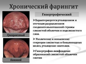 xronicheskiyfaringitsimptomilechenieuvzr F0087E0A - Симптомы и лечение хронического фарингита у взрослых, фото горла