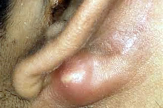 xronicheskiygnoyniyotitsrednegouxasimpto ED7A324C - Хронический гнойный средний отит уха