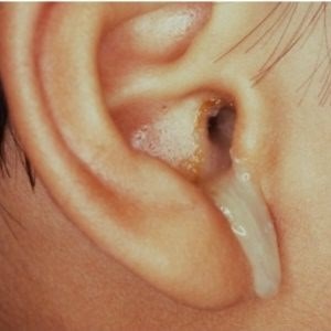 xronicheskiygnoyniyotitudeteyivzroslixsi B6D64AC1 - Туботимпанальный отит среднего уха, симптомы и лечение