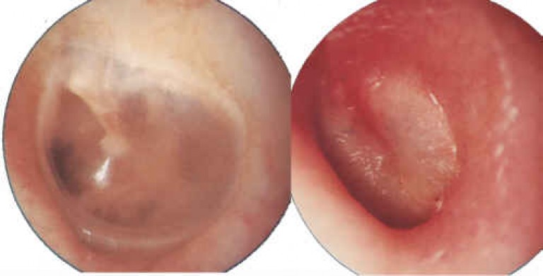 xronicheskiygnoyniyotitudeteyivzroslixsi F9D1EC88 - Туботимпанальный отит среднего уха, симптомы и лечение