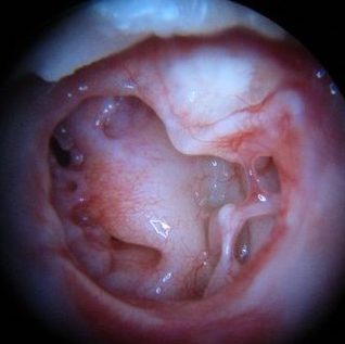 xronicheskiygnoyniysredniyotituxa 12F8A417 - Хронический гнойный средний отит уха
