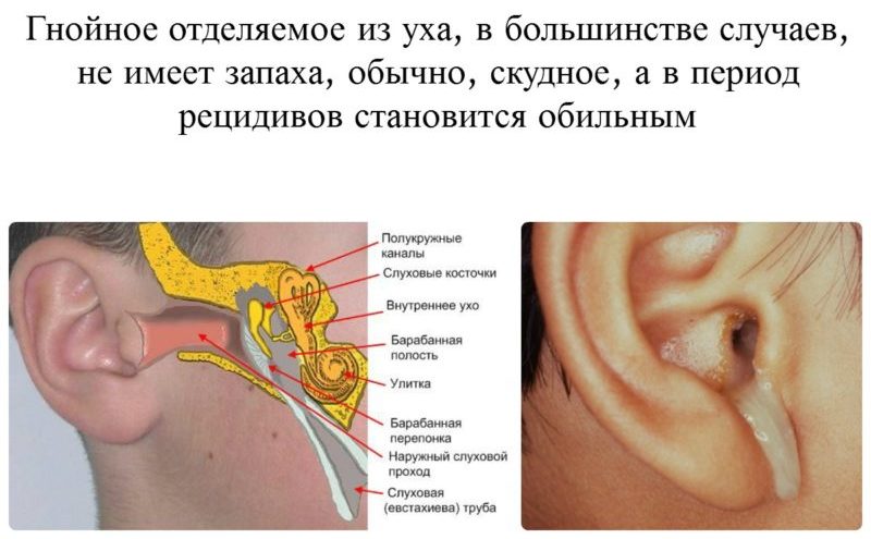 xronicheskiygnoyniysredniyotituxa 23FAB3CC - Симптомы гайморита: признаки гайморита у взрослых, как проявляется патология?