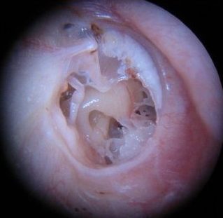xronicheskiygnoyniysredniyotituxa B66D0D3C - Хронический гнойный средний отит уха