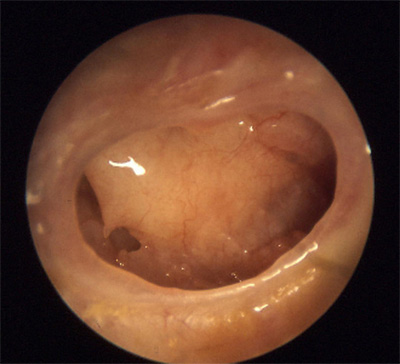 xronicheskiyotit 71BEEB7B - Операция на ухо при хроническом гнойном отите