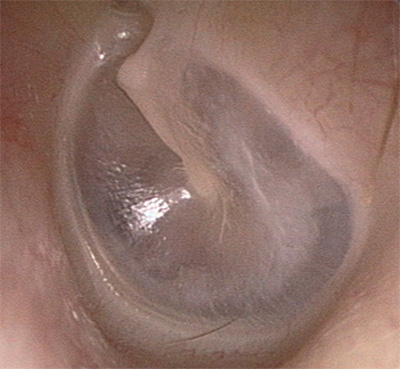 xronicheskiyotit 7A34FA33 - Операция при отите среднего уха
