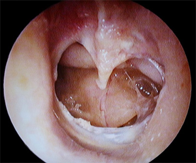 xronicheskiyotit A0E679DC - Операция на ухо при хроническом гнойном отите