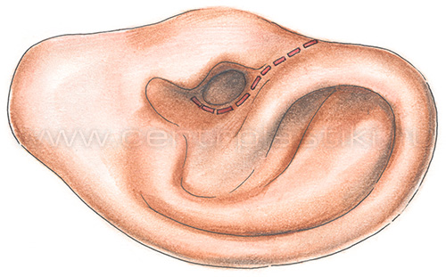 xronicheskiyotit AA5EFA22 - Операция на ухо при хроническом гнойном отите