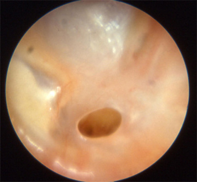 xronicheskiyotit B7F947B5 - Операция на ухо при хроническом гнойном отите