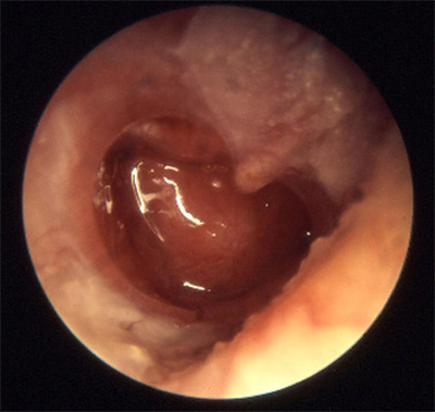 xronicheskiyotit CDF4CADF - Операция на ухо при хроническом гнойном отите