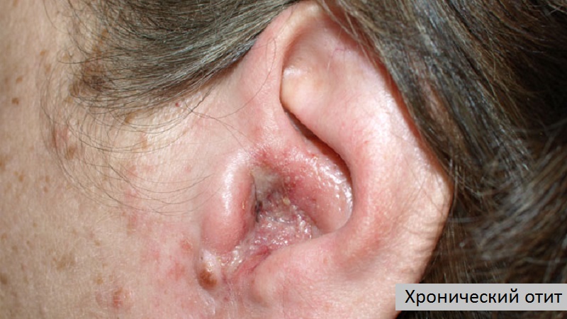 xronicheskiyotitlechenieisimptomilecheni B612F601 - Хронический отит уха – симптомы и лечение у взрослых и детей