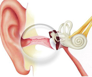 xronicheskiyotitsimptomiilechenie F2566248 - Хронический отит уха – симптомы и лечение у взрослых и детей