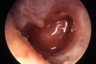 xronicheskiyotituxasimptomiilechenieuvzr 8F00C5CC - Пульсирует в ухе: причины стука и пульса в органах слуха, почему бьется в ухе пульс, но не болит?