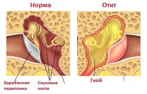 xronicheskiyotitvidisimptomipriznakiilec A3235503 - Хронический отит уха – симптомы и лечение у взрослых и детей