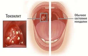 xronicheskiytonzilliturebenkasimptomiile D4079835 - Суспензия гидрокортизона, мазь и капли в ухо — способ применения, дозировка и противопоказания