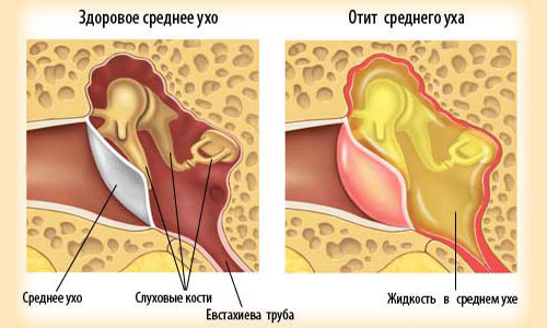 zvonishumvuxeushaxposleotita ED96FE56 - Шум в ухе после отита, причины методы лечения